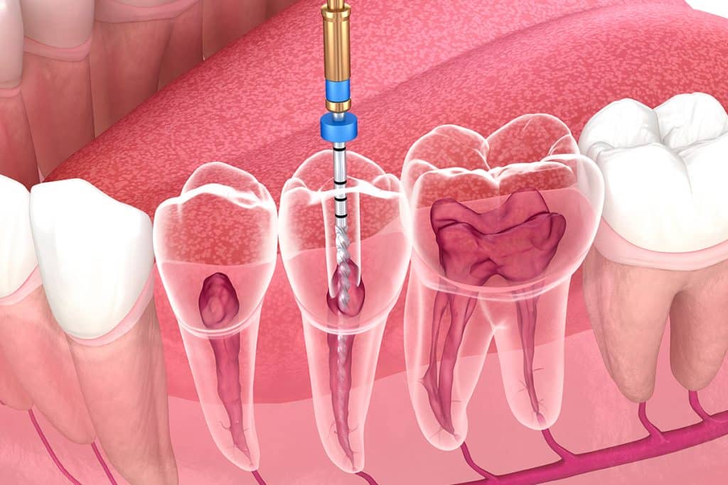 What is Endodontic Retreatment?